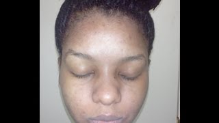 How kojic acid soap changed my face week 4 before and after pictures [upl. by Ianaj629]