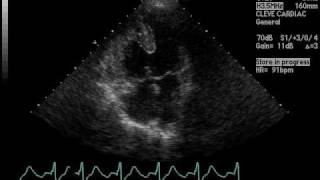 Atrioventricular AV Septal Defect Repair [upl. by Slavic]