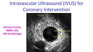 Intravascular Ultrasound IVUS for Coronary Intervention [upl. by Carlos]