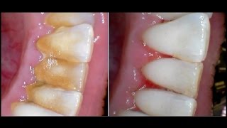 How To Remove Plaque Without Going To The Dentist 2016 [upl. by Maitilde]