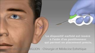 Earfold  une technique non chirurgicale pour les oreilles décollées  Dr Corniglion [upl. by Kcirde]