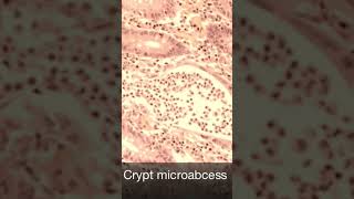 Gland crypt micro abscess in ulcerative colitis [upl. by Azeria889]