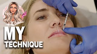 Watch this full treatment of RUSSIAN LIPS  Dermal filler  Before amp after [upl. by Anived]