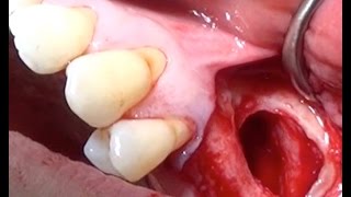 Maxillary Sinus liftSurgical Video [upl. by Eward659]