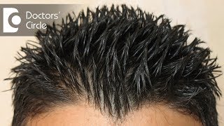 How to treat Androgenic Alopecia not responding to minoxidil amp finasteride  Dr Aruna Prasad [upl. by Medor]