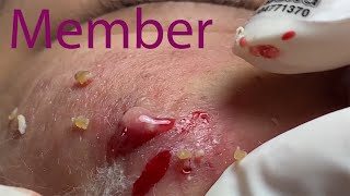 Acne Treatment Huong Da Nang 024  fans membership [upl. by Clayborne]