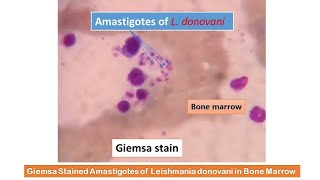 Giemsa Stained Amastigotes of Leishmania donovani in Bone Marrow [upl. by West377]