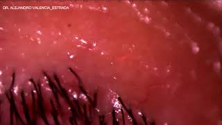 IRIDOTOMIA YAG LASER [upl. by Annah]