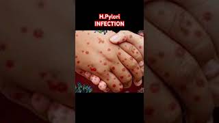 🦠 HPylori Infection Explained 😷 stomach infection shorts [upl. by Salguod968]