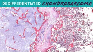 Dedifferentiated Chondrosarcoma with osteosarcoma heterologous area  hemipelvectomy UNC case 7 [upl. by Eisenberg537]