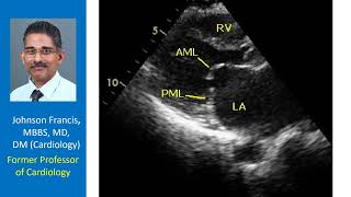 This echocardiogram was taken in parasternal long axis view What is the diagnosis [upl. by Ssor]