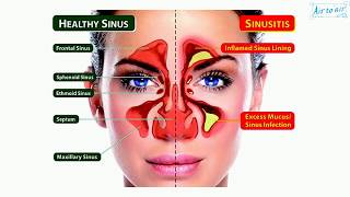 catarrh English  Medical terminology for medical students [upl. by Monteria]