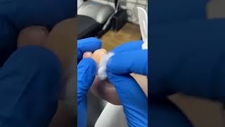 Watch a Podiatrist Expertly Remove a Big Toe Callus with Scalpel [upl. by Hartwell]