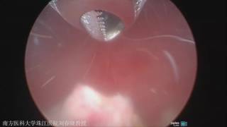 Minimally Invasive Surgery  Morcellator Surgery Video Prof ChunXiao Liu [upl. by Lliw]