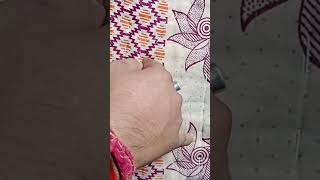 Radial nerve wrist drop recovery 15 month whatsapp [upl. by Selokcin87]