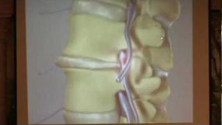 Lumbar Spinal Stenosis Part 2  Treatment Options Paul Houle MD [upl. by Vey]