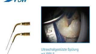 VDW Dental · How To VDWULTRA  Ultraschallgestützte Spülung [upl. by Abbub]