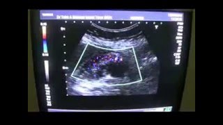 ADENOMYOMATOSIS of the GALL BLADDER [upl. by Alel]