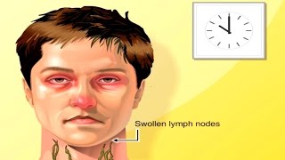 Why Lymph Nodes Swell Animation  Lymphatic System Structure amp Function Anatomy amp Physiology Video [upl. by Lacombe]