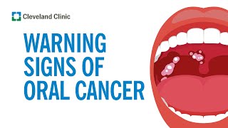 How to Screen Yourself for Oral Cancer [upl. by Berkman]