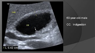 Adenomyomatosis of gallbladder [upl. by Sid]