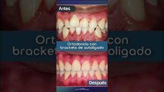 Ortodoncia con brackets de autoligado ¿listo para alinear tu sonrisa [upl. by Barmen]