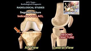 ACL Tears Radiological Evaluation  Everything You Need To Know  Dr Nabil Ebraheim [upl. by Enairda]