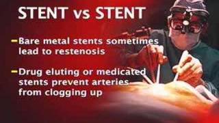 New study on medicated stents [upl. by Isbel711]