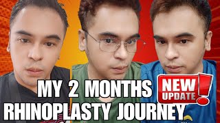 MY 2 MONTHS RHINOPLASTY JOURNEY by Doc Lacson of Kosmed From Day One to 2 Months [upl. by Llyrat375]