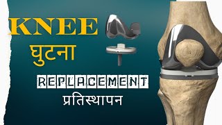 knee arthroplasty no cement [upl. by Yblocaj]