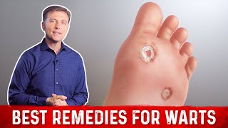 4 Best Wart Removal Remedies – Dr Berg on Wart Treatment at Home [upl. by Annodam]