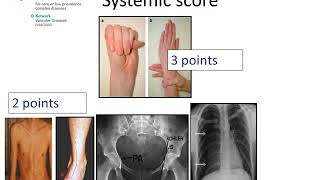 Marfan Syndrome  Diagnosis by Prof Julie De Backer [upl. by Eelanej]