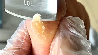 Callus removal from feetampFoot scraping dead skin【Xiao Yan pedicure】stress 3 [upl. by Atekihc]