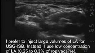 UltrasoundGuided Interscalene Brachial Plexus Block [upl. by Noseyt358]