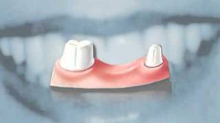 Dental Crowns Bridges and Implants  Simply Explained [upl. by Greyso]