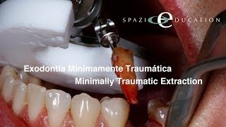 Exodontia Minimamente Traumática  Minimally Traumatic Extraction [upl. by Takara]