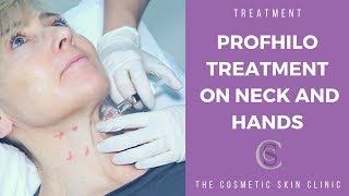 Profhilo Treatment On Neck and Hands  The Cosmetic Skin Clinic [upl. by Valentijn]