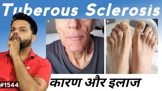 Tuberous Sclerosis Causes Symptoms amp Treatment In Hindi [upl. by Asilem]