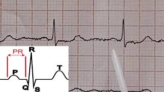 ECG Interpretation tres facile de l ECG 9eme partie Lecture d un ECG Normal [upl. by Chapell]