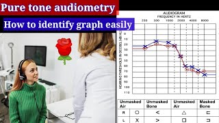 Pure tone Audiometry Graph 📊 🔴conductive hearing loss Sensorineural hearing loss Mixed hearing [upl. by Suelo247]