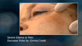 EndyMed PRO fractional skin resurfacing training video [upl. by Belayneh]