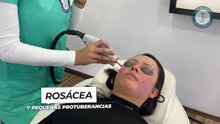 😳¿Quieres Conocer un Tratamiento Para La Rosácea El Láser Vbeam Candela Te Ayudará✅😎 Racderma [upl. by Solegna]