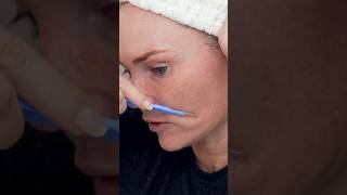 Dermaplaning at home with 10R blade [upl. by Rehsa]