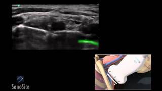 How To Ultrasound Guided Interscalene Nerve Block 3D Video [upl. by Hatnamas]