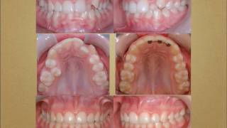 Cas traités en orthodontie orthodontistes Lemaymov [upl. by Shulock]