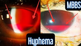 Injury to the eye Hyphema medicine mbbs neetpg usmle inicet neet aiims ophthalmology [upl. by Tattan753]