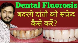 DENTAL FLUOROSIS TREATMENT WITH COST [upl. by Odella]