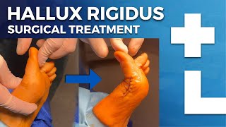 Hallux rigidus surgery  cheilectomy Moberg osteotomy  Dworska hospital® [upl. by Croydon]