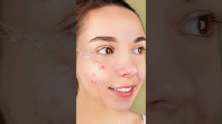 What Causes Acne Understanding and Managing Breakouts Acne facts healthtips AcneTreatment Skin [upl. by Ynavoeg]