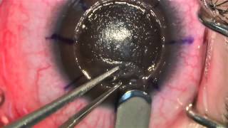 Anterior Lamellar Keratoplasty [upl. by Inavoj20]